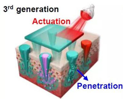 第三代：通过微针介导的皮肤层破坏和微针伴随的各种功能增强药物转运.jpg